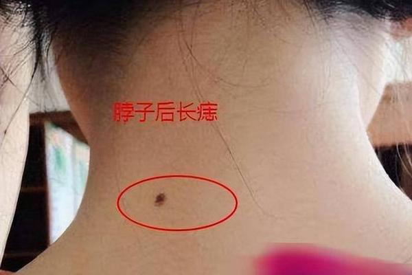 少食痣相,三餐不饱痣长在哪里图片