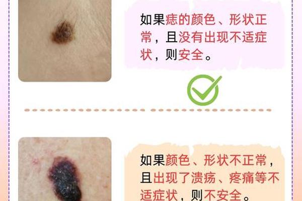 痣相长毛有讲究吗—痣长毛了是好还是不好