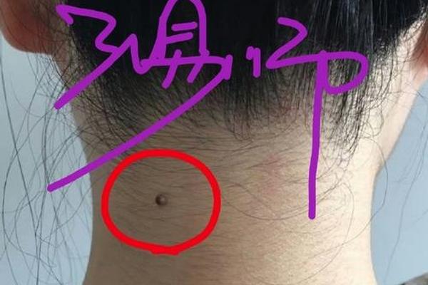脖子区域痣相-脖子长痣的位置图解