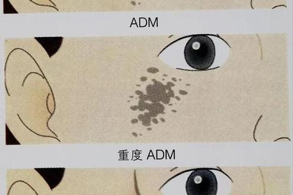 痣和斑相—痣与斑的区别图片