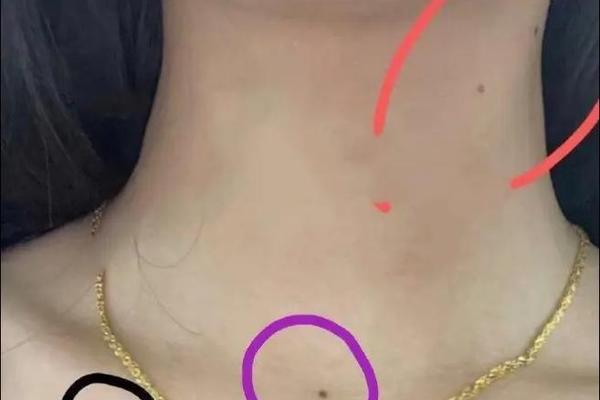 痣相锁骨痣;锁骨痣的位置与命运的关系