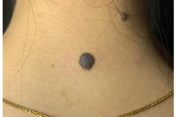 痣相女脖子图解_脖子上长痣代表什么图解法