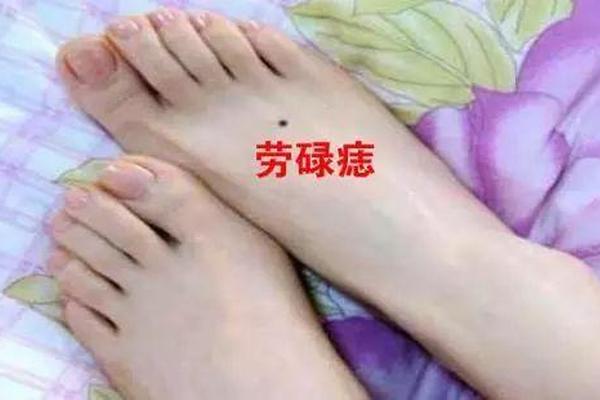 脚背上的痣麻衣神相-脚背的痣图解