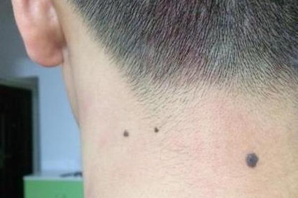 男人颈子痣相;男人脖子最吉利的痣图