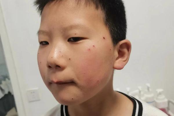 小孩面部痣相—小孩脸上有痣图片