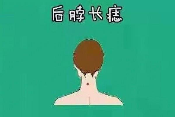 男脖子前正中间痣相 男人后脖颈正中间有痣