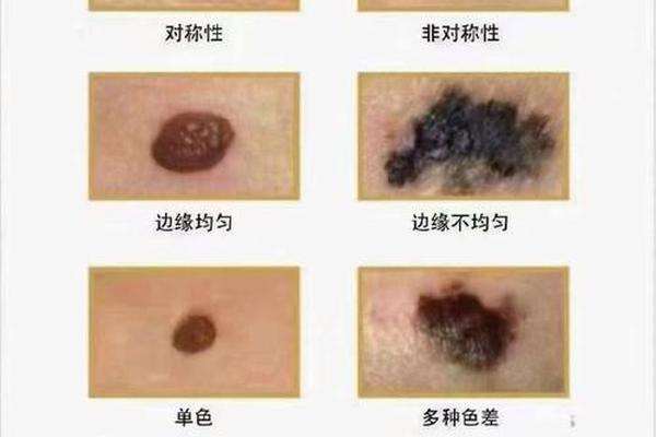 痣相有道理,黑痣真的有命运一说吗