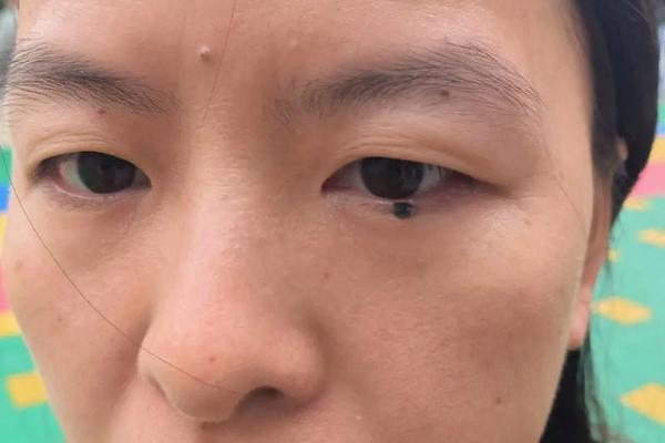 痣相 流泪、痣相流泪是什么意思