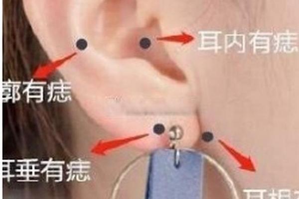 痣相大全图解长痣(耳垂下长痣代表什么图解)