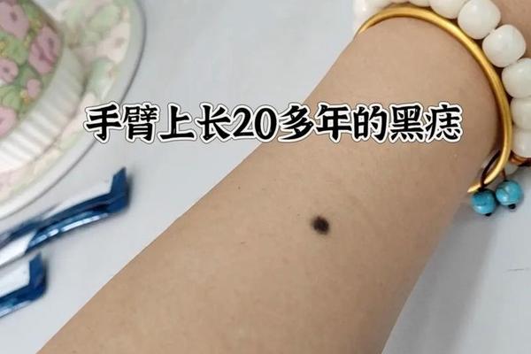 痣相女手痣相图解大全—女人手臂有痣图解