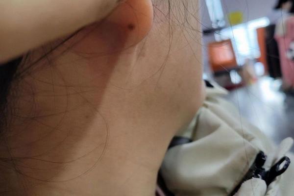 痣相女人耳朵后面—耳朵后面长痣代表什么女 痣相女人耳朵后面—耳朵后面长痣代表什么女