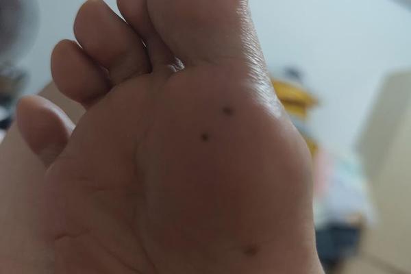 男人脚底三颗红痣相解说;脚底红痣的位置和命运