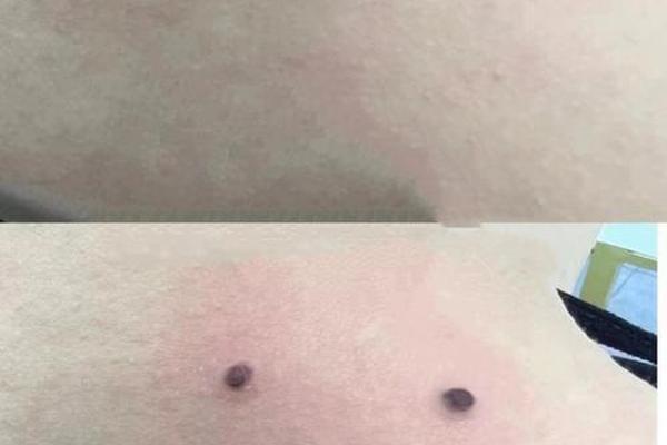 背后面痣相_后背有痣命苦