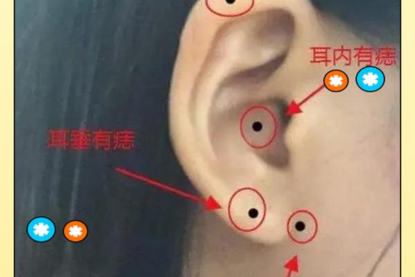 耳朵上有痣的人富相、耳朵上的折富痣是什么意思