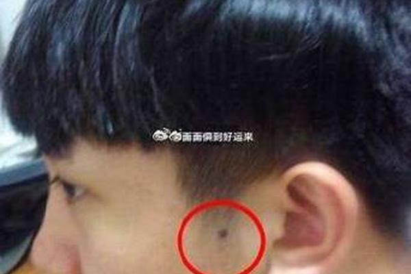 男鬓角面部痣相_男人鬓角有痣好吗