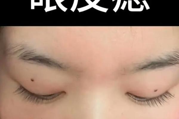 眼俭上有痣相,长在眼睑上的痣图片