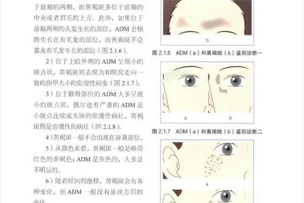痣相斑算吗(痣和斑的区别图解)