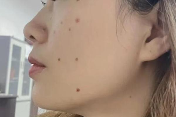 韩国相师点痣视频大全—韩国艺人都去点痣吗