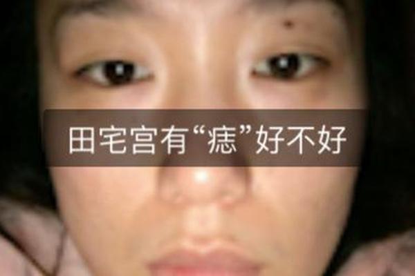 田宅宫痣相_田宅宫的痣哪些是吉痣