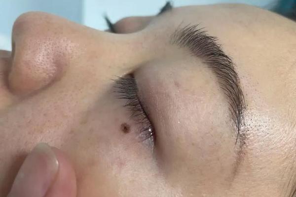 痣相泪猴、什么是眼泪痣