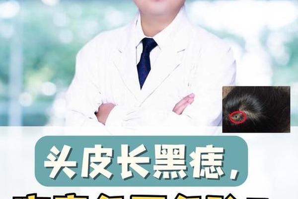 头发里面痣相;左侧头发里面有痣代表