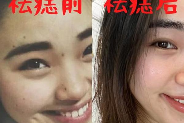相法疤痕痣吉凶(手术去痣会留疤痕吗)