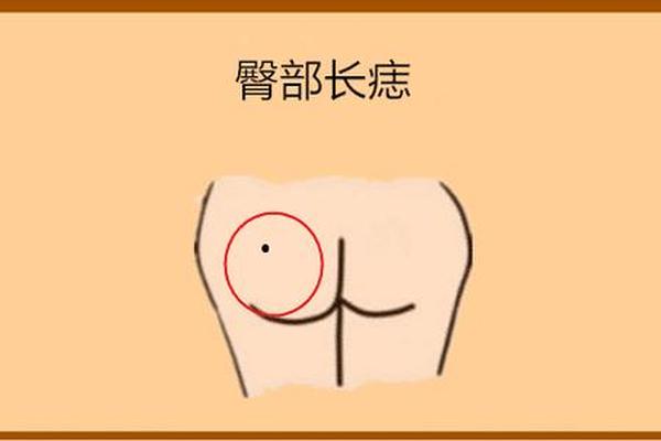 屁股痣相解图、胯骨上方痣图解大全 屁股痣相解图、胯骨上方痣图解大全
