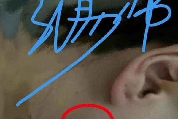 耳朵下面痣相-耳朵下边的痣