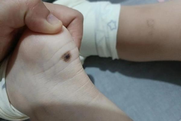 痣相很圆很黑;痣越黑越不好吗