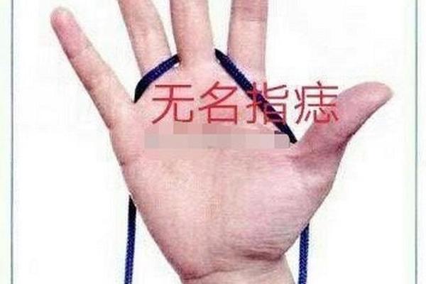 无名指上有痣相 无名指内侧长痣