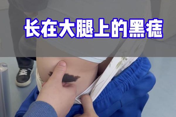 左大腿中间痣相—大腿有痣代表什么意思