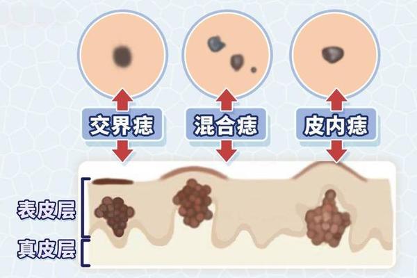 皮下痣细胞有成熟记相-痣细胞有成熟现象是什么意思