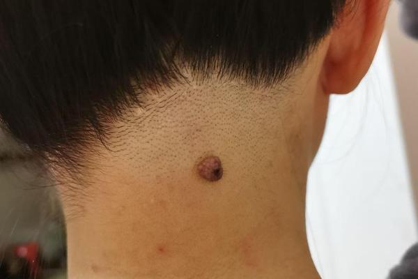 男性脖子痣相全解-男生后脖子中间有痣