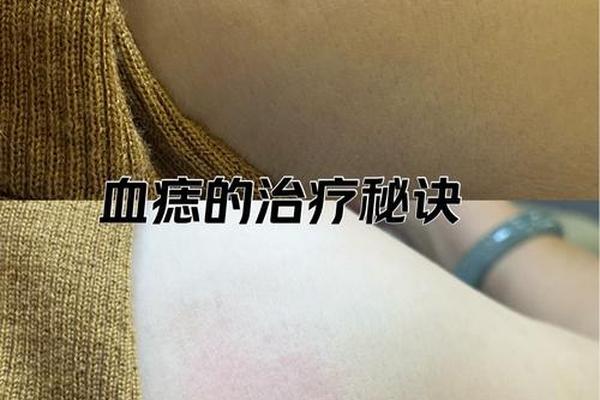 痣相发际线红痣;发际线上方一点长了一颗红痣