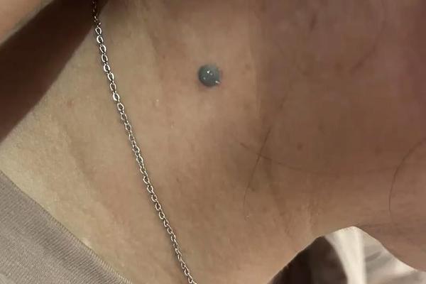 脖子痣相大全图解,脖颈有痣 痣相图解