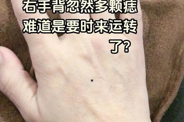 手背相痣图(手背痣相图解大全图解)