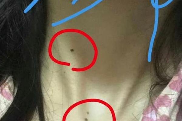 痣相+肩下-脖子和肩膀之间有痣