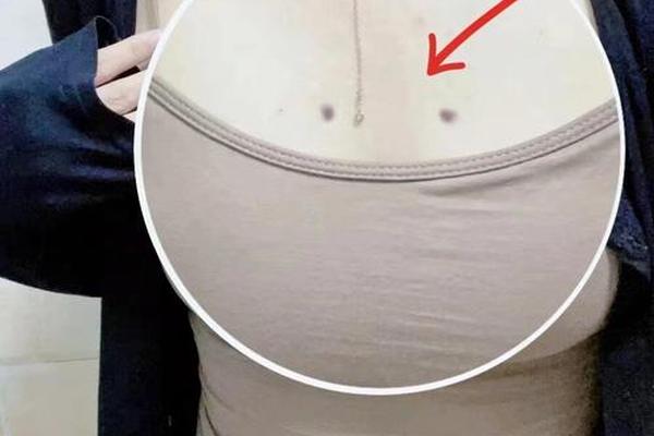 女人胸上有痣富相,女性有痣好吗