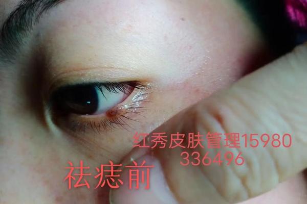 如何看眼袋下面的痣相 眼睑正下方有痣