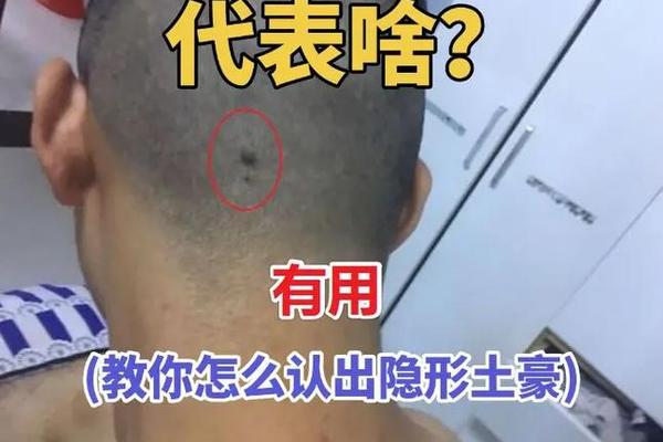 痣相后面 头上有痣图解大全