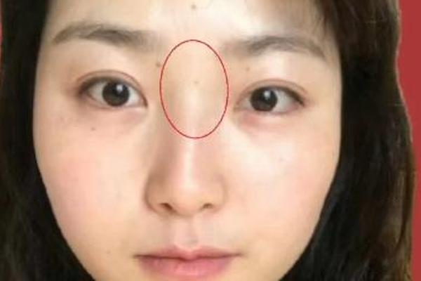女相山根有痣_山根旁边有痣
