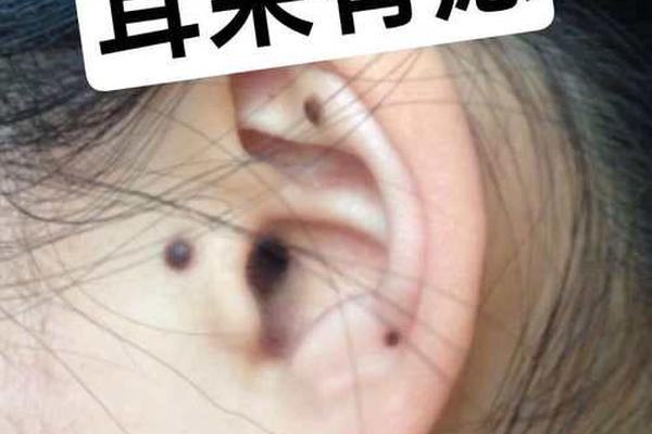 男人耳朵附近痣一相全解_男人痣相图解十大福痣
