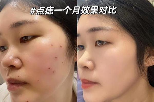 相城第二医院可以点痣吗—二甲医院能点痣吗