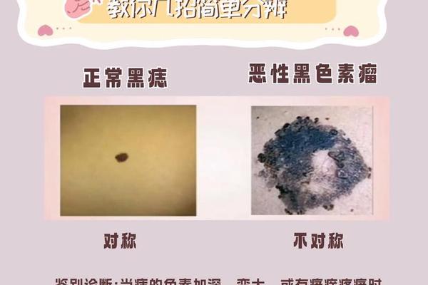 痣相吉是什么意思 吉痣与恶痣的区别