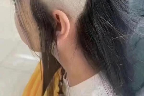 相城医院有没有点痣的针,点痣用的工具像一根针