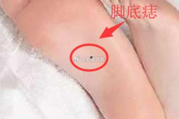 外脚踝下面痣相;脚踝痣相图解