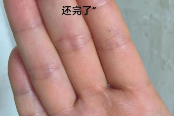 右手无名指痣相;右手无名指有一颗痣