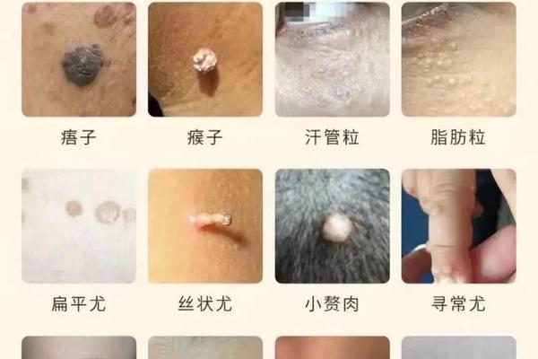 痣相上有肉痣好不好、脸上长肉痣好不好