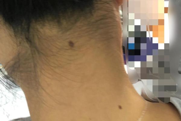 右边脖有棕痣是什么相(棕色痣是善痣还是恶痣)