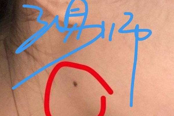 腮腺痣相-腮帮子上的痣